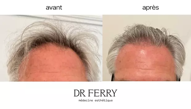 Greffe de cheveux