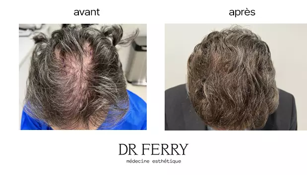 Greffe de cheveux