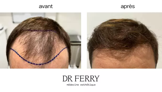 Greffe de cheveux
