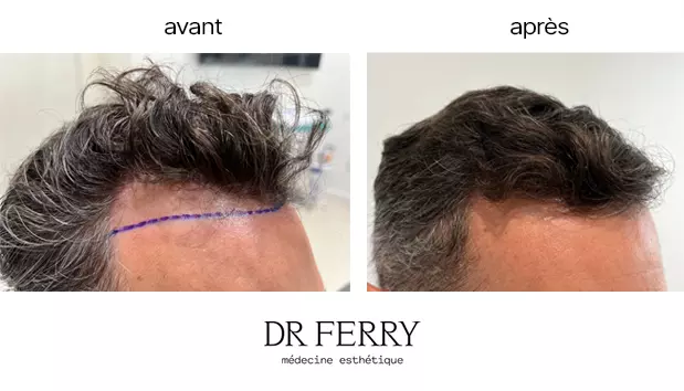 Greffe de cheveux